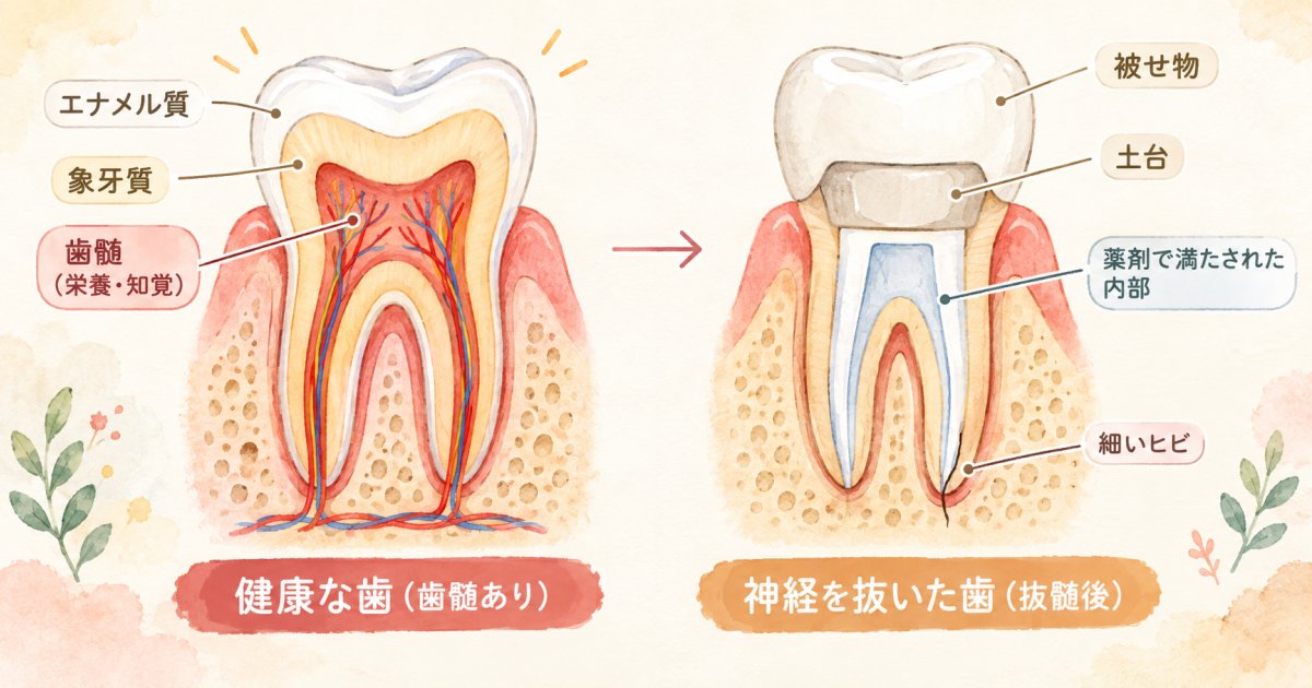 歯の神経を抜くと歯が欠けやすくなるのはなぜか