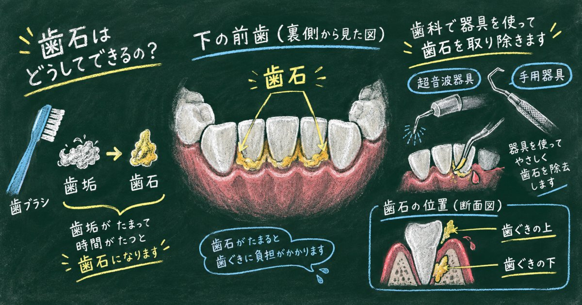 前歯の裏の歯石が取れない理由は？歯科での除去と出血の疑問